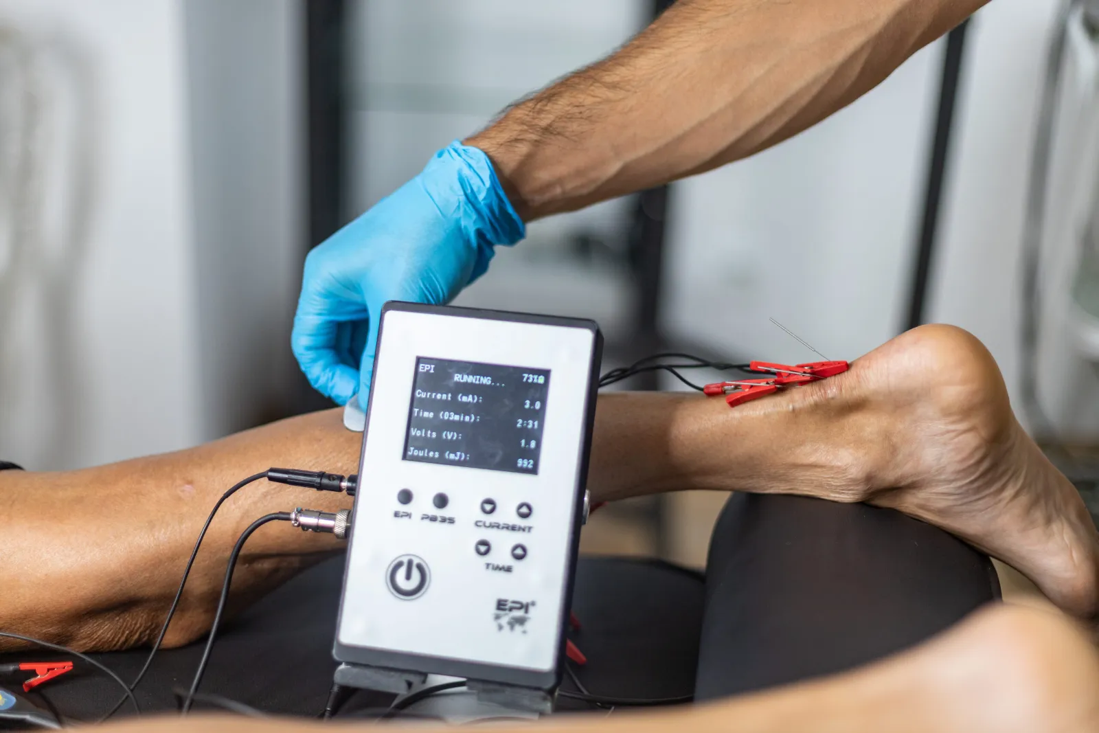 Aplicación de electrólisis percutánea intratisular (EPI) en la pierna de un paciente