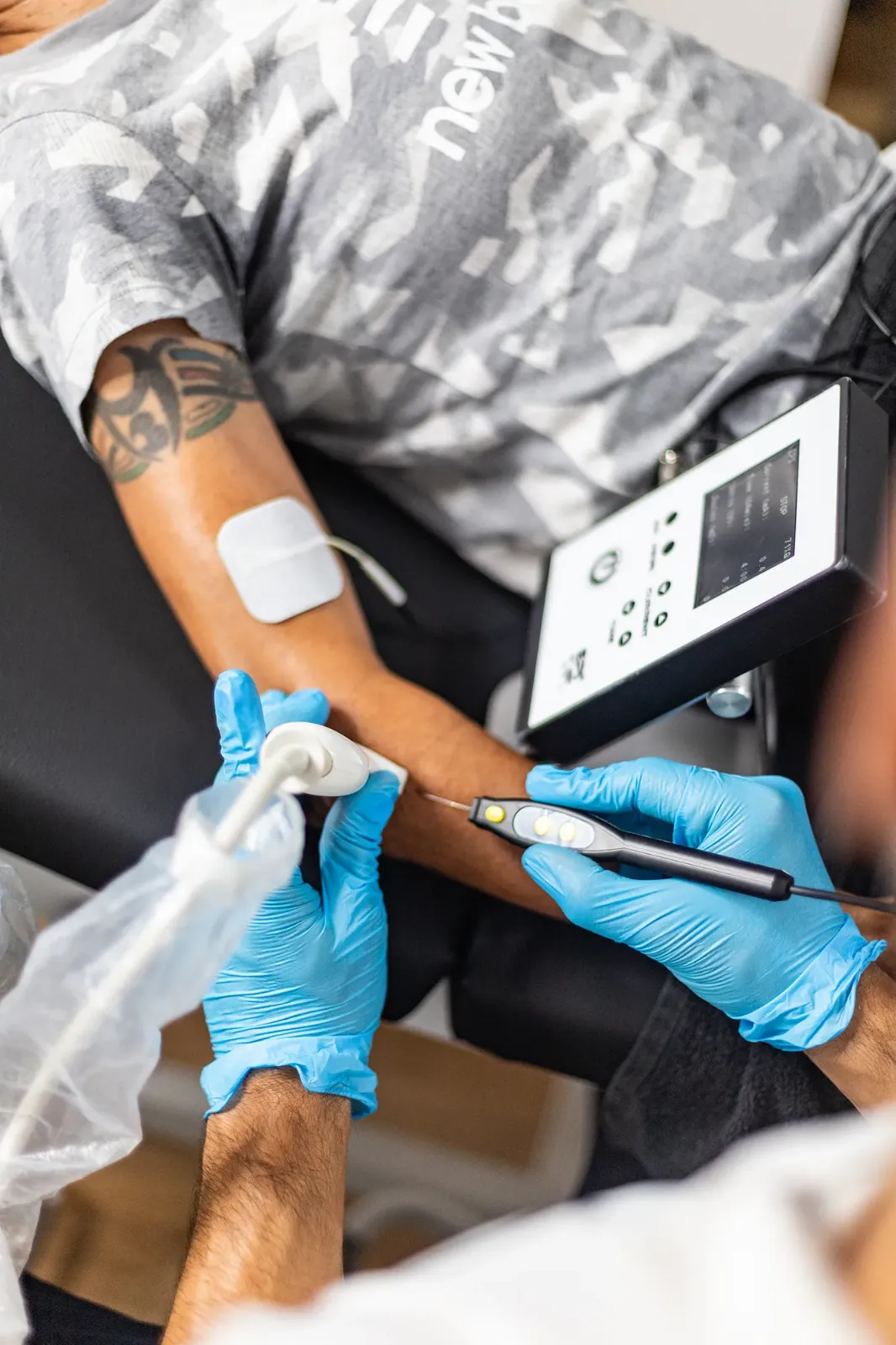 Fisioterapeuta aplicando neuromodulación percutánea en la pierna de un paciente